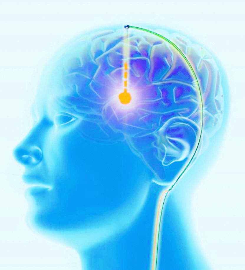 Estimulaci N Cerebral Profunda Es Tratamiento De Varias Enfermedades