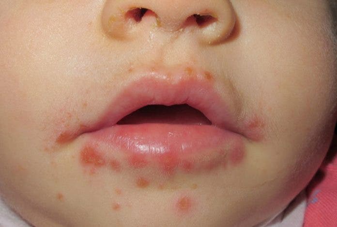 Fiebre aftosa humana