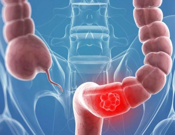 Diabetes aumenta el riesgo de padecer cáncer colorrectal