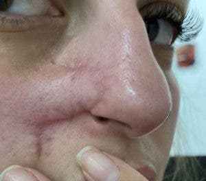 Marca en el rostro por cirugía Daiane.