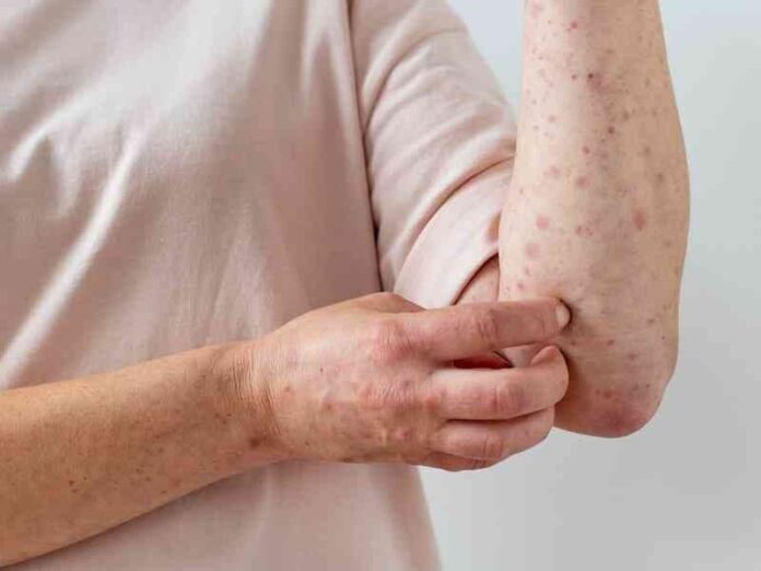 Los casos de viruela símica se han reducido un 90 por ciento en los tres últimos meses