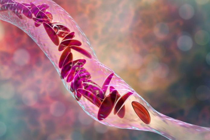 La nueva terapia génica para pacientes con anemia de células falciformes
