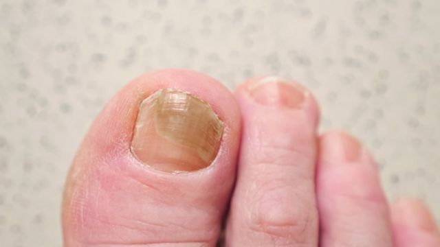 Uña con micosis.