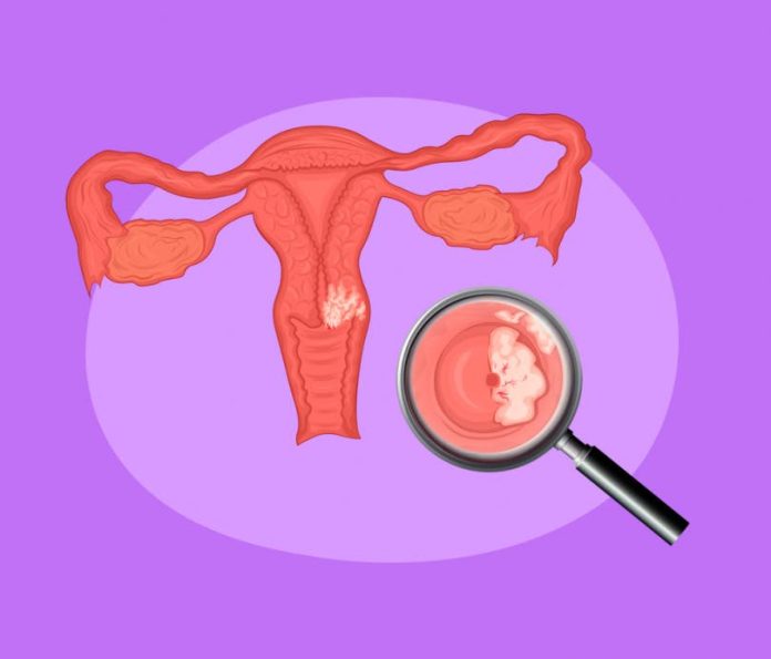 Una nueva prueba para detectar el cáncer de útero reduce la mayoría de falsos positivos