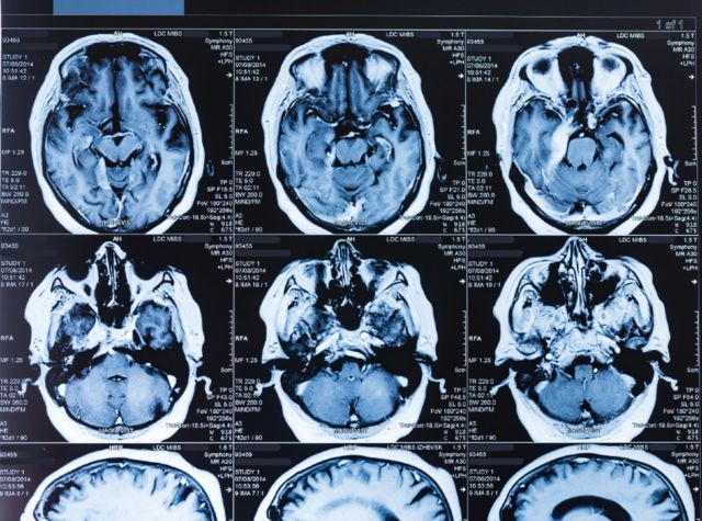 Imágenes por resonancia magnética del cerebro